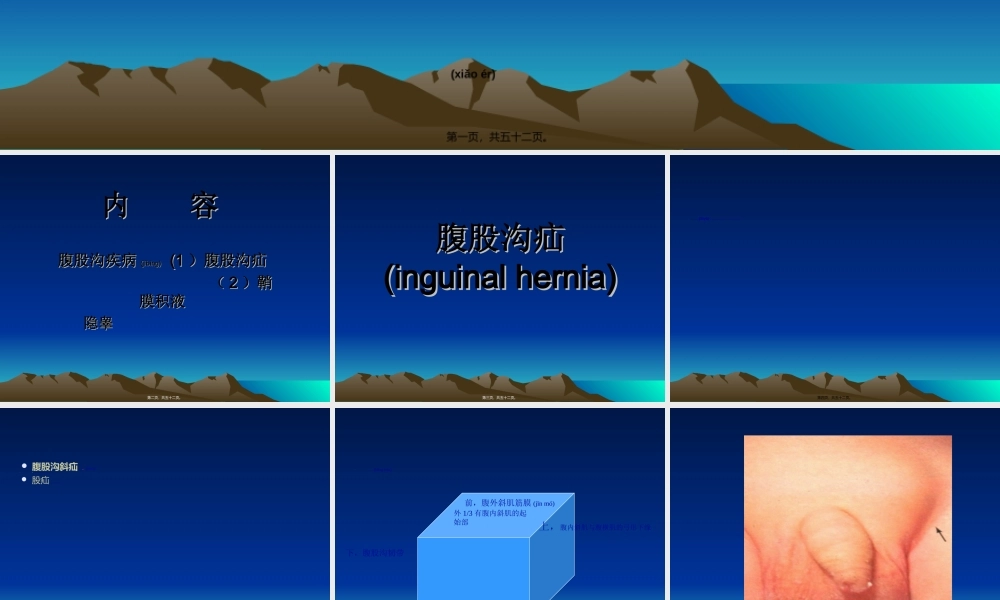 2022年医学专题—腹股沟疝鞘膜积液隐睾.ppt