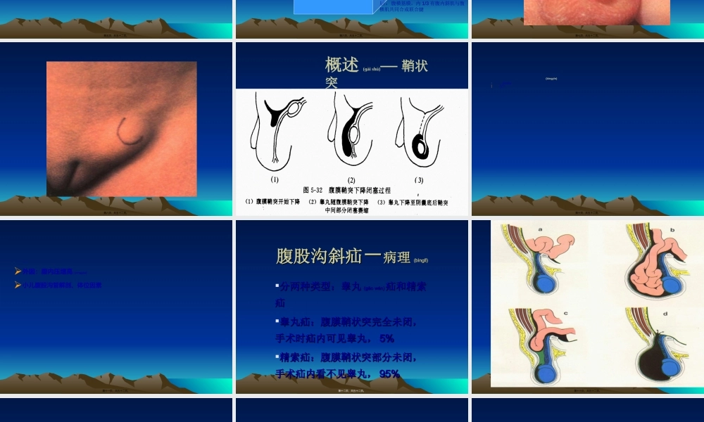 2022年医学专题—腹股沟疝鞘膜积液隐睾.ppt