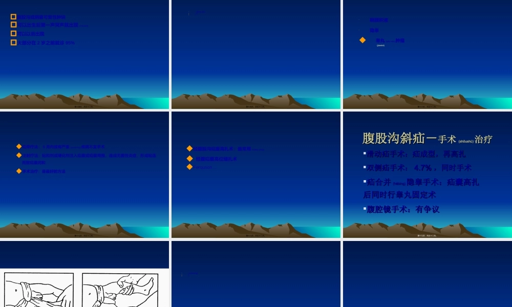 2022年医学专题—腹股沟疝鞘膜积液隐睾.ppt