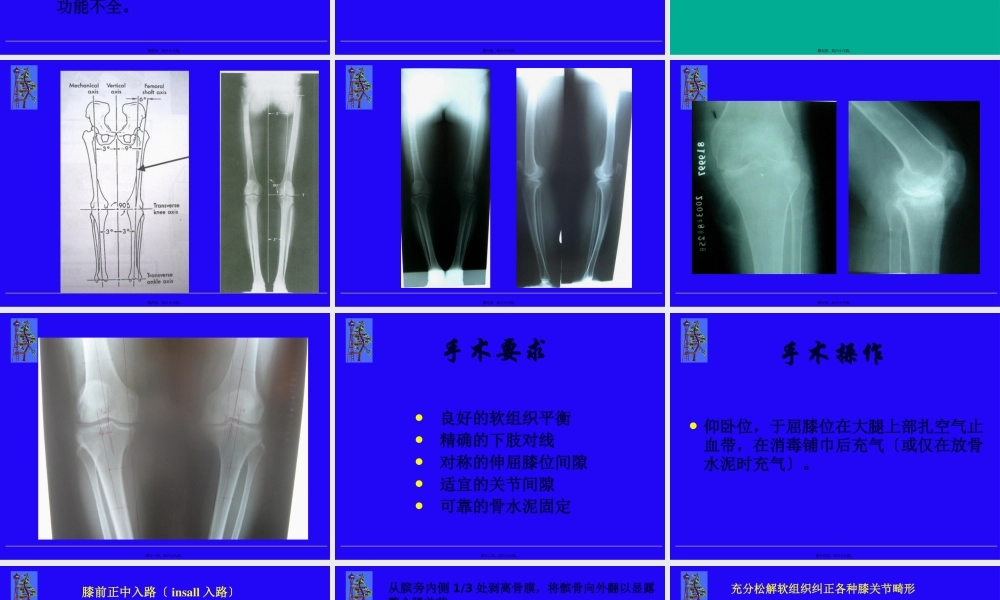 全膝关节置换.pptx