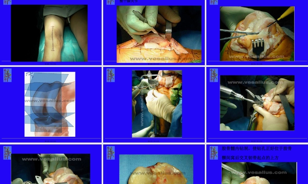 全膝关节置换.pptx