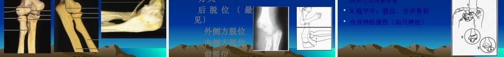 关节脱位损伤.pptx