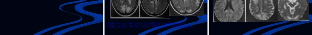 后部可逆性脑病综合征.pptx