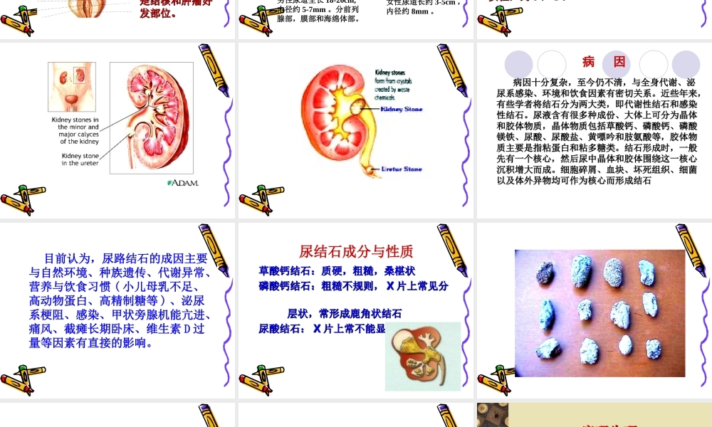 泌尿系结石梗阻.ppt