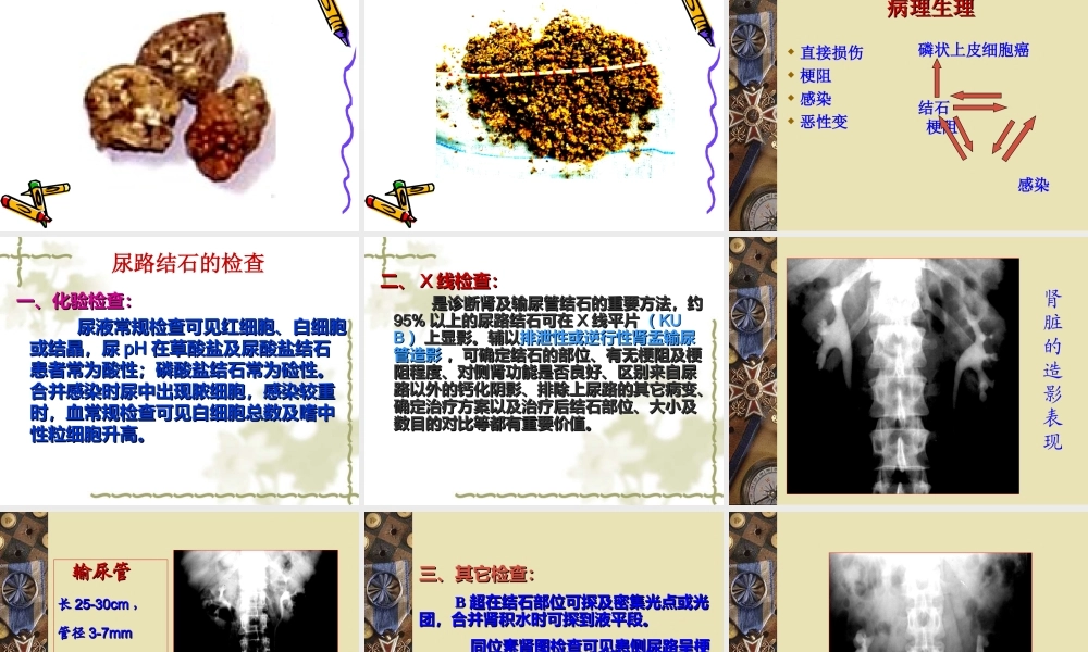 泌尿系结石梗阻.ppt