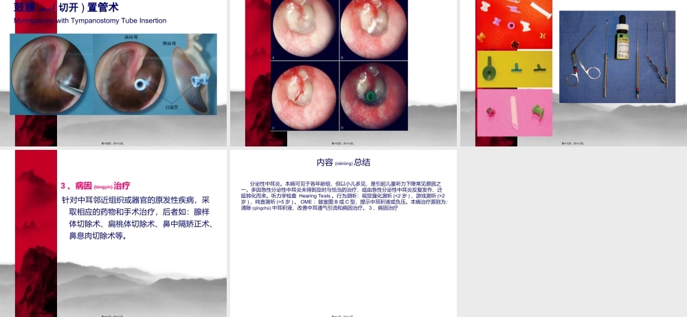 2022年医学专题—分泌性中耳炎(新)实习.ppt