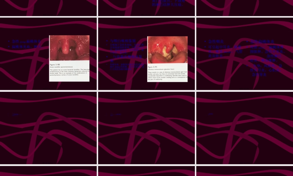 2022年医学专题—急性咽炎、急性扁桃体炎2.ppt