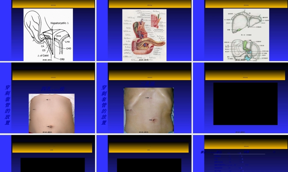 2022年医学专题—腹腔镜下胆囊切除术(LC).ppt