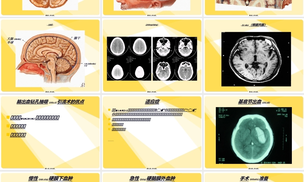 2022年医学专题—脑出血钻孔抽吸引流术.ppt