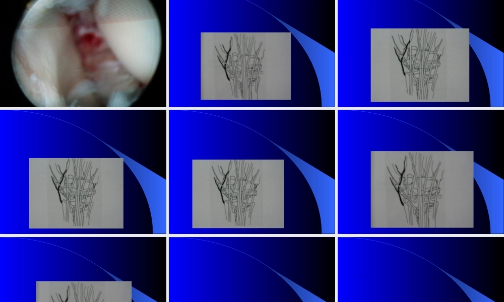 2022年医学专题—内窥镜在手外科的应用.ppt