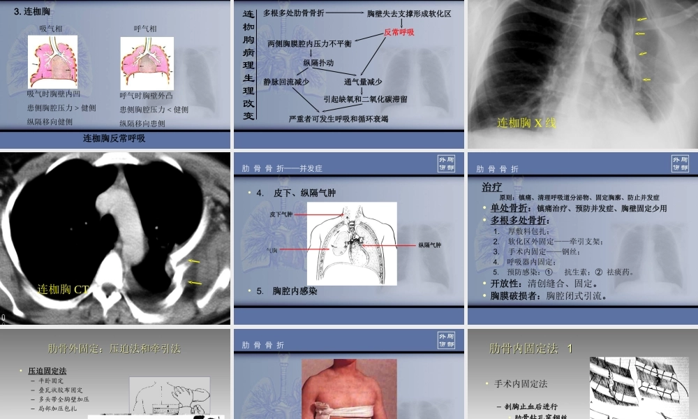 胸部损伤肋骨骨折.ppt