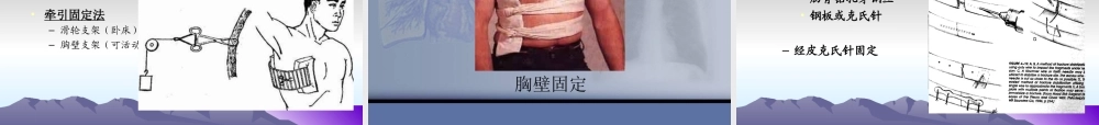 胸部损伤肋骨骨折.ppt