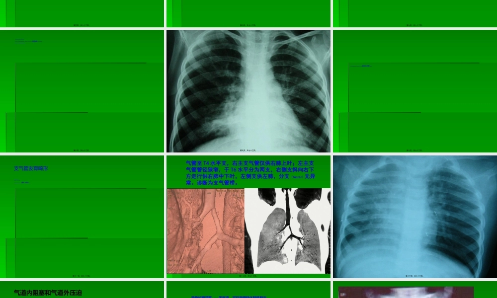 2022年医学专题—最易忽视又常见的慢性肺炎.ppt