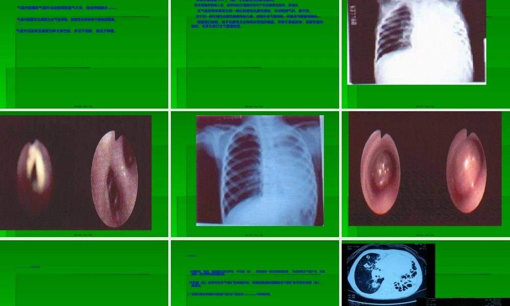 2022年医学专题—最易忽视又常见的慢性肺炎.ppt