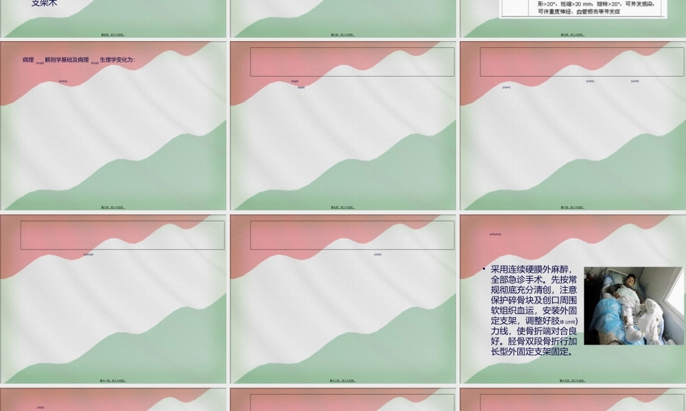 2022年医学专题—胫骨外固定支架.ppt