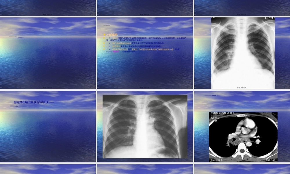 2022年医学专题—肺TB.ppt