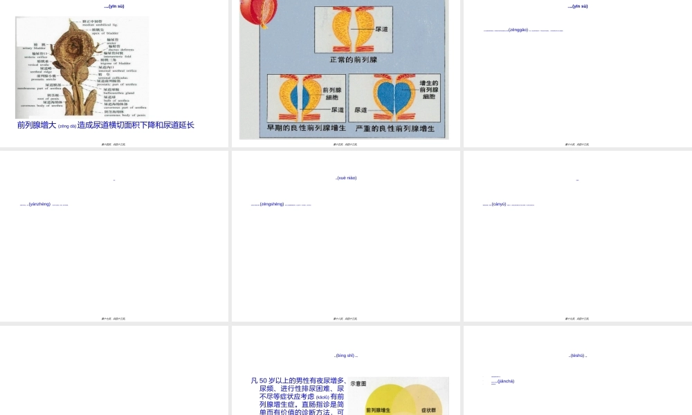 2022年医学专题—前列腺增生症.ppt