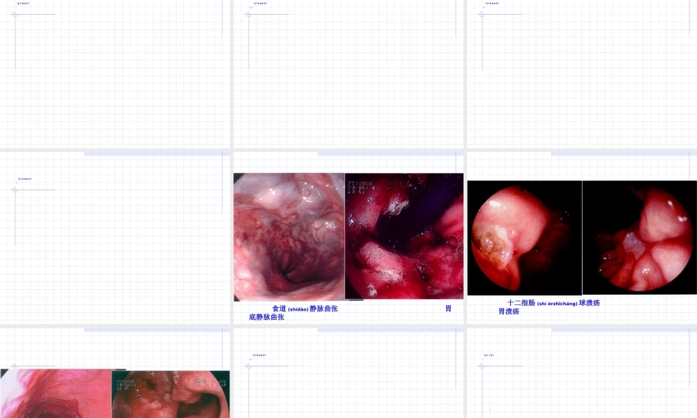 2022年医学专题—上消化道出血02.ppt