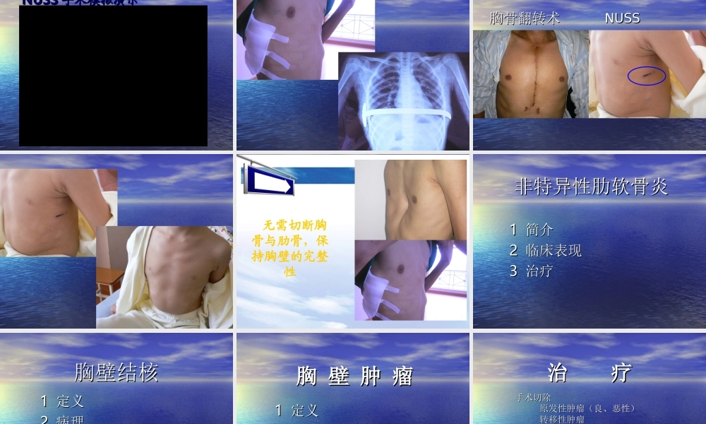114外科-胸壁疾病(1).ppt