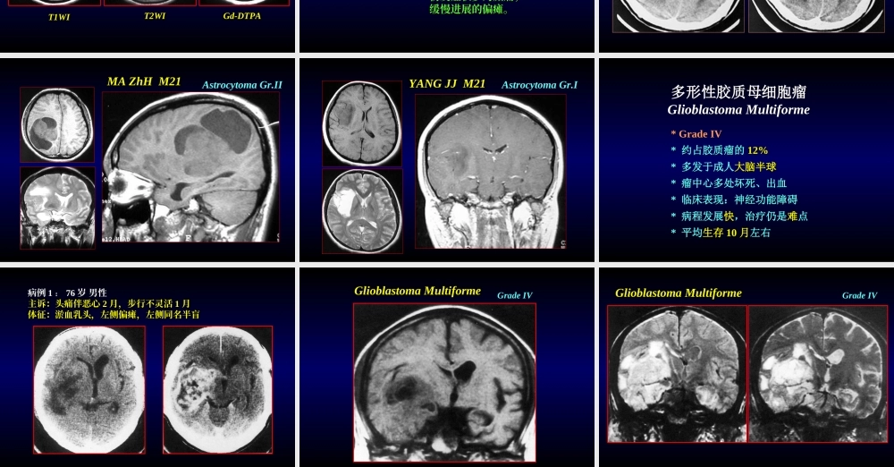 153肿瘤科-颅脑肿瘤(1).ppt