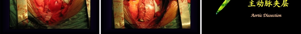 157主动脉外科(1).ppt