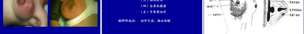 13妇产科-乳房疾病(1).ppt