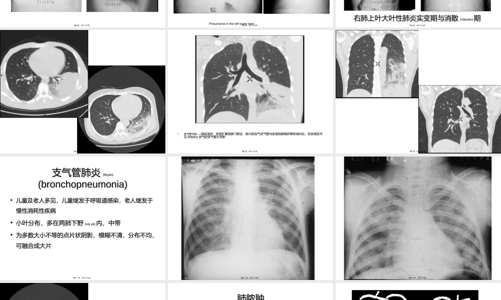 2022年医学专题—呼吸系统影像学第二部分.ppt