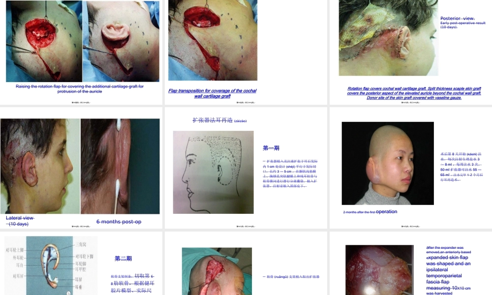 2022年医学专题—小耳畸形重建.ppt