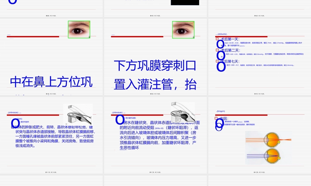 2022年医学专题—恶性青光眼病例分析讲诉.ppt