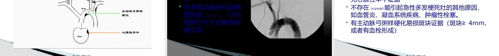 2022年医学专题—缺血性卒中的病因分型.pptx