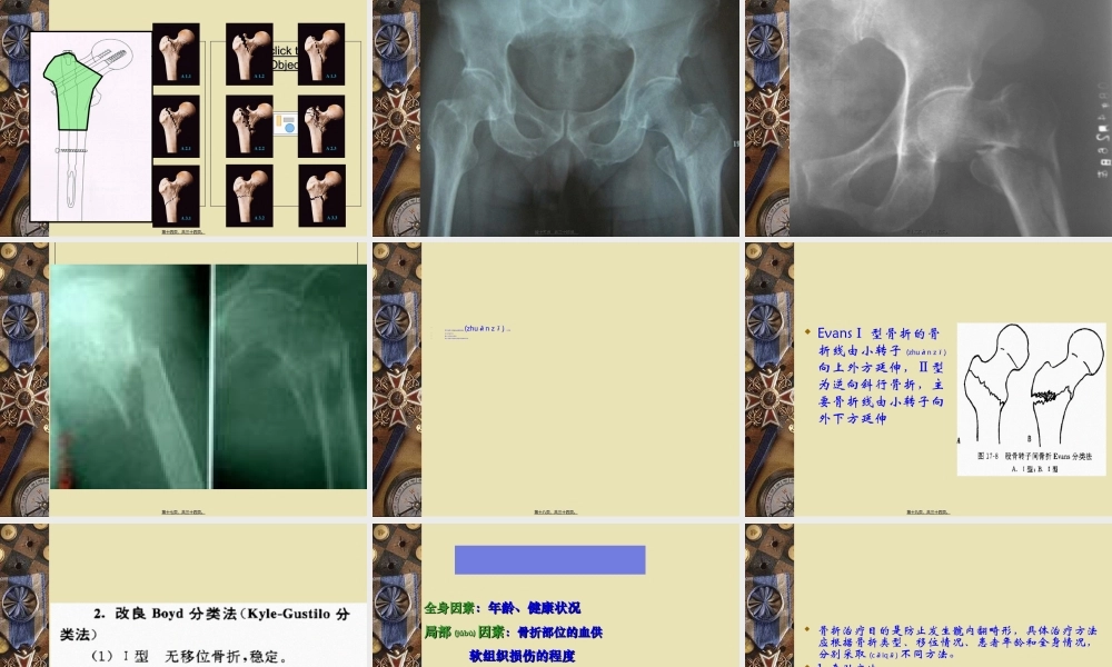 2022年医学专题—股骨粗隆间骨折新.ppt