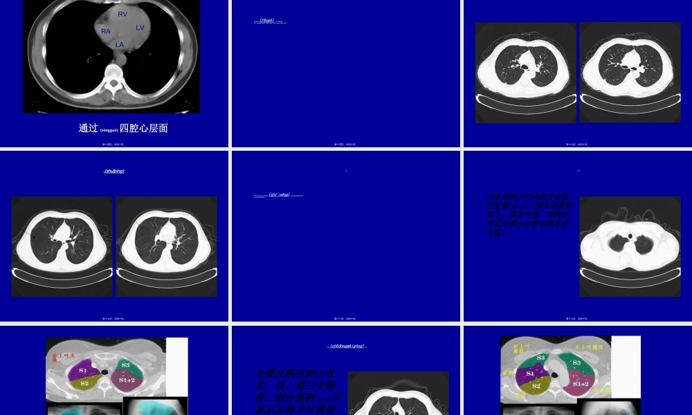 2022年医学专题—胸部CT基础知识.ppt
