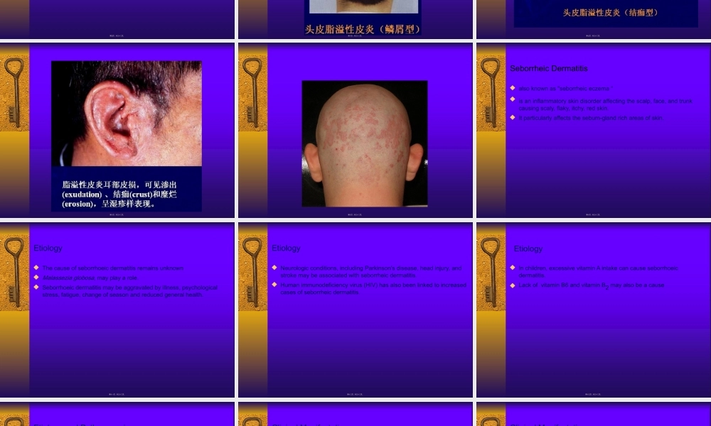 2022年医学专题—脂溢性皮炎...ppt