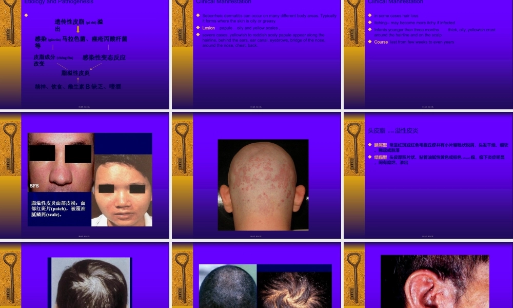2022年医学专题—脂溢性皮炎...ppt