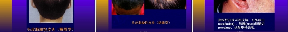2022年医学专题—脂溢性皮炎...ppt