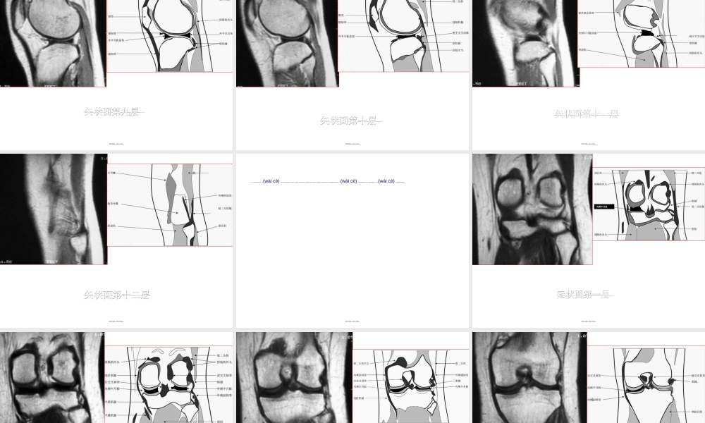 2022年医学专题—膝关节创伤的MRI.ppt