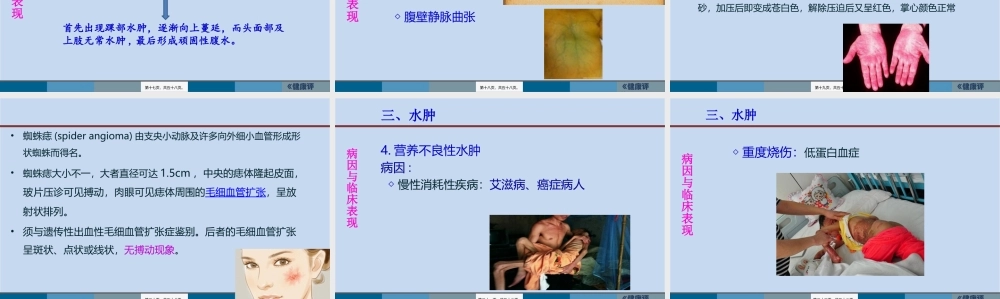 3水肿脱水新.pptx