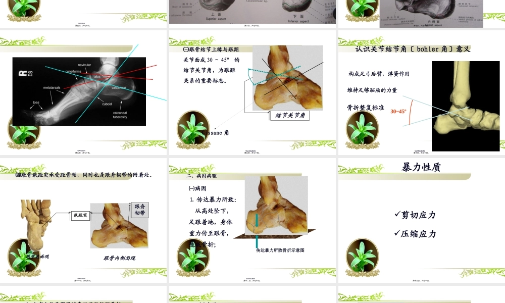 3跟骨骨折.pptx