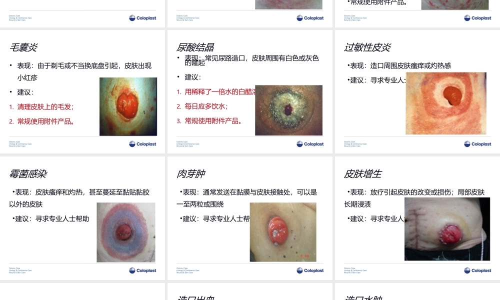 3造口并发症介绍.ppt