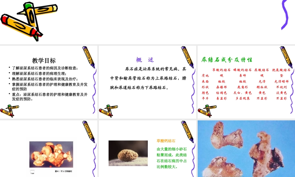 46泌尿科-泌尿系结石病人的护理(1).ppt