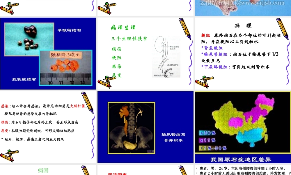 46泌尿科-泌尿系结石病人的护理(1).ppt