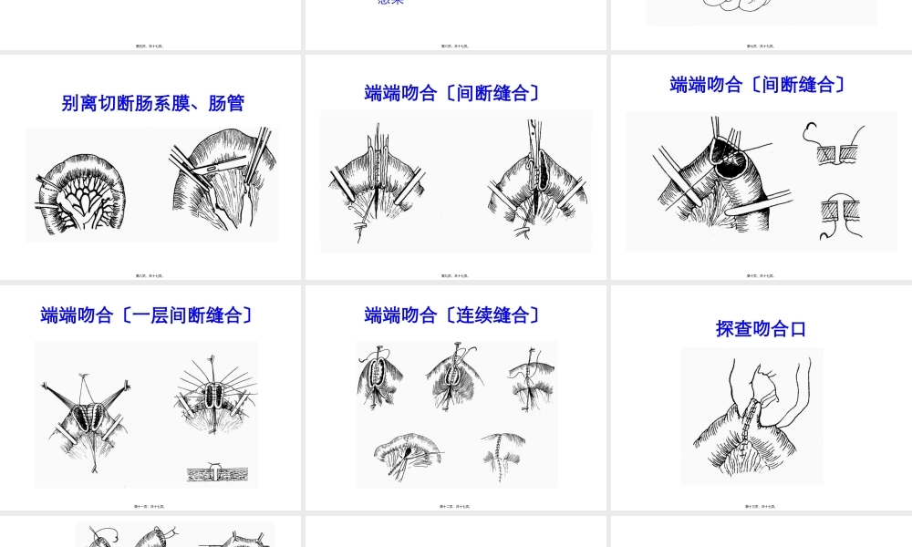 4小肠切除吻合术.pptx