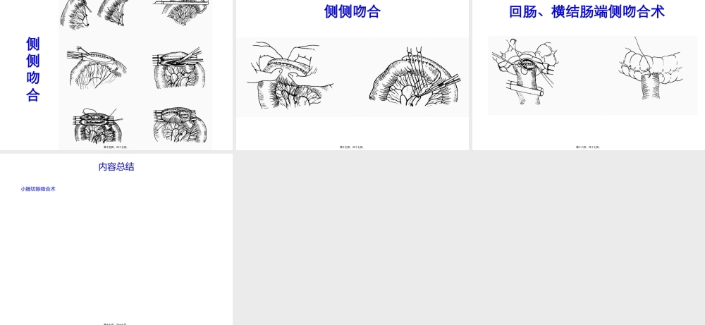 4小肠切除吻合术.pptx