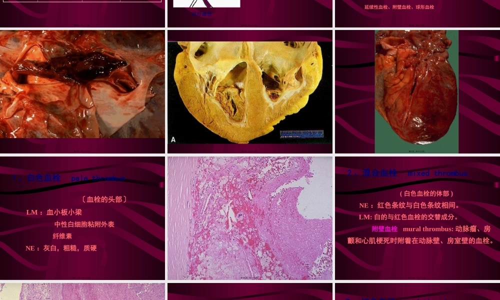 4局部血液循环障碍(二).pptx