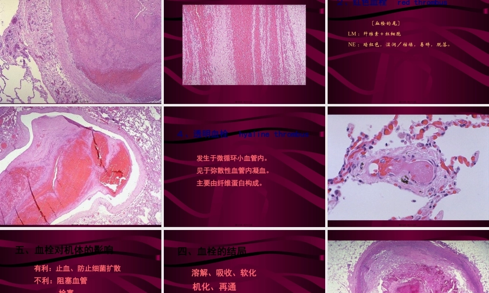 4局部血液循环障碍(二).pptx