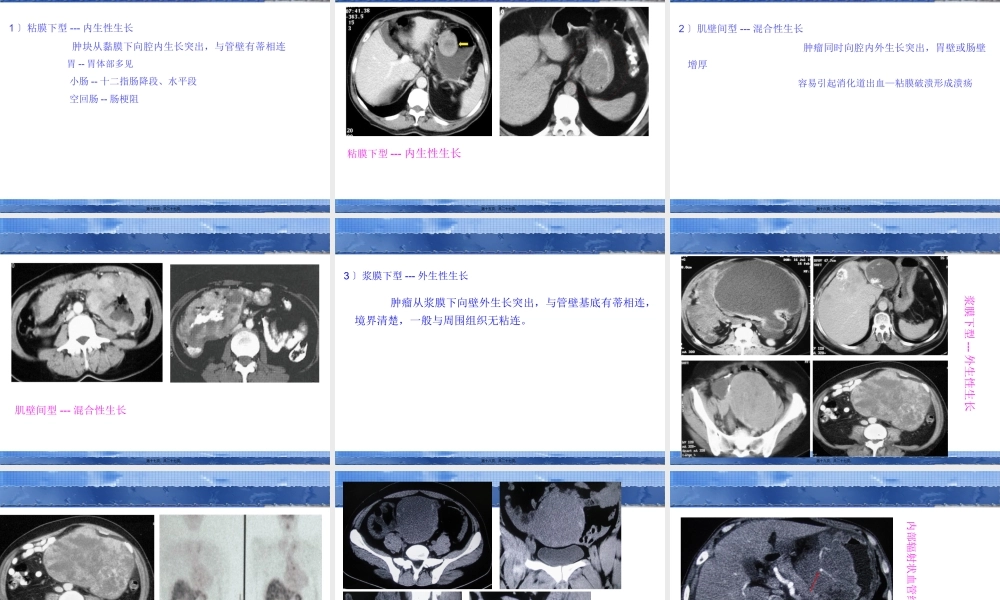 58-胃肠道间质瘤的影像学表现.pptx