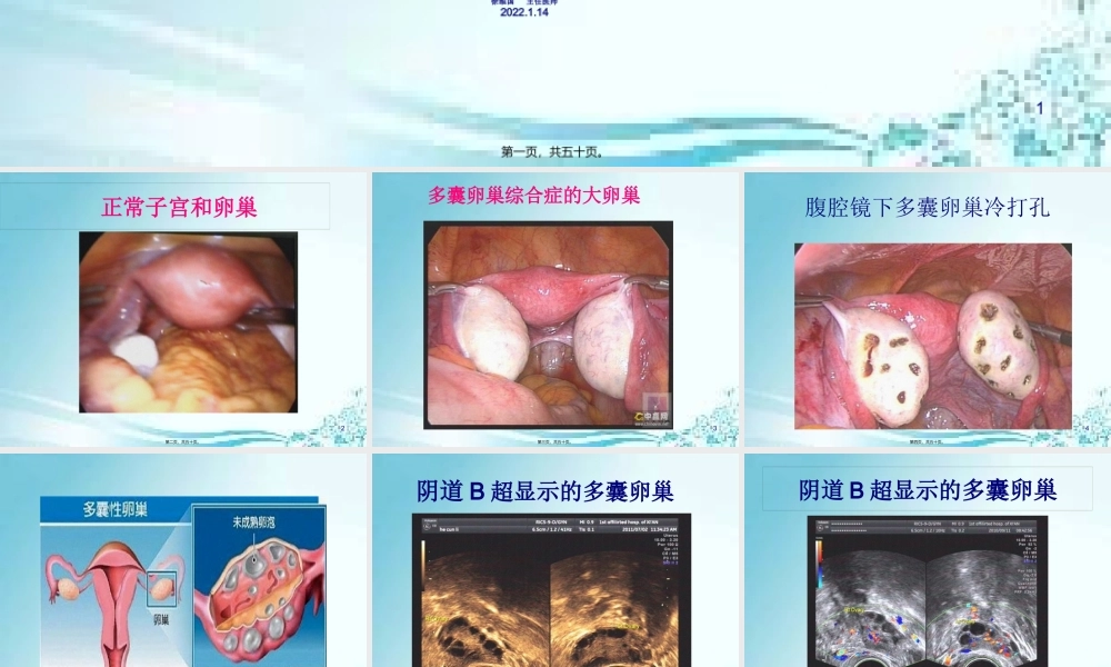 5、多囊卵巢综合症(PCOS).pptx