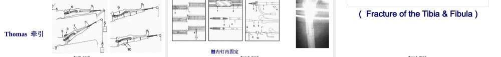 6.3第六章-第三节下肢骨折.pptx