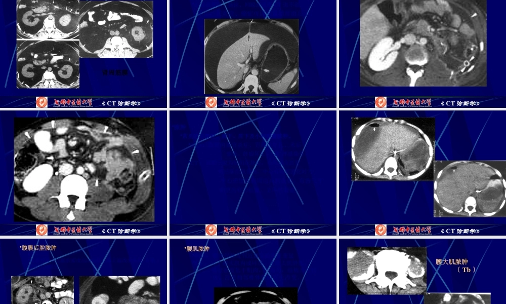 7腹膜腔、腹膜后CT检查.pptx