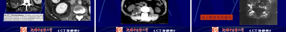 7腹膜腔、腹膜后CT检查.pptx